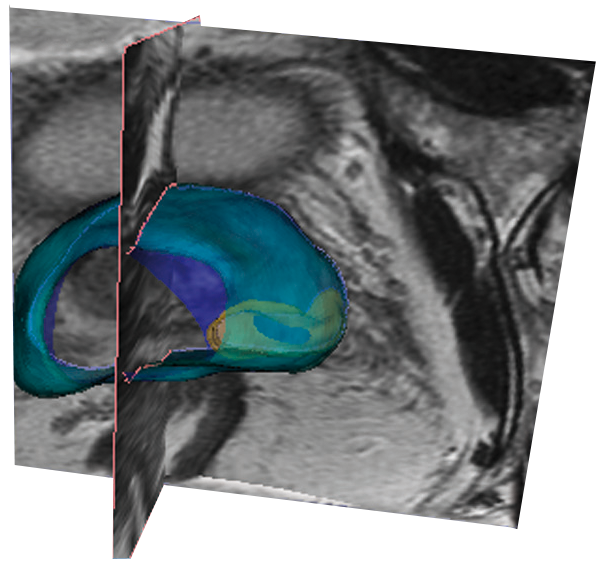Cancer de la prostate: un robot révolutionnaire à la polyclinique d’Arnas