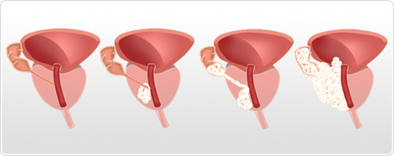 stades cancer de la prostate